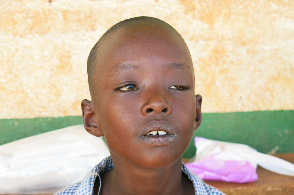 samburu boy with drooping eyelid